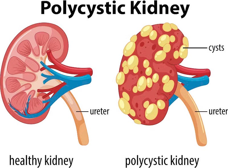 Cysts in Polycystic Kidney Disease